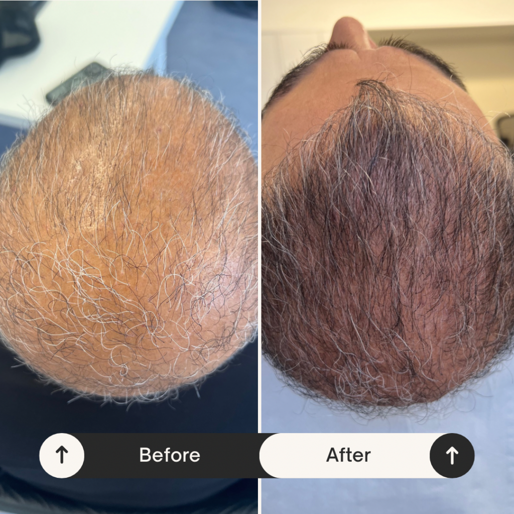 Haarausfall, Haartransplantation, Ergebnisse nach 3. PRP Behandlung