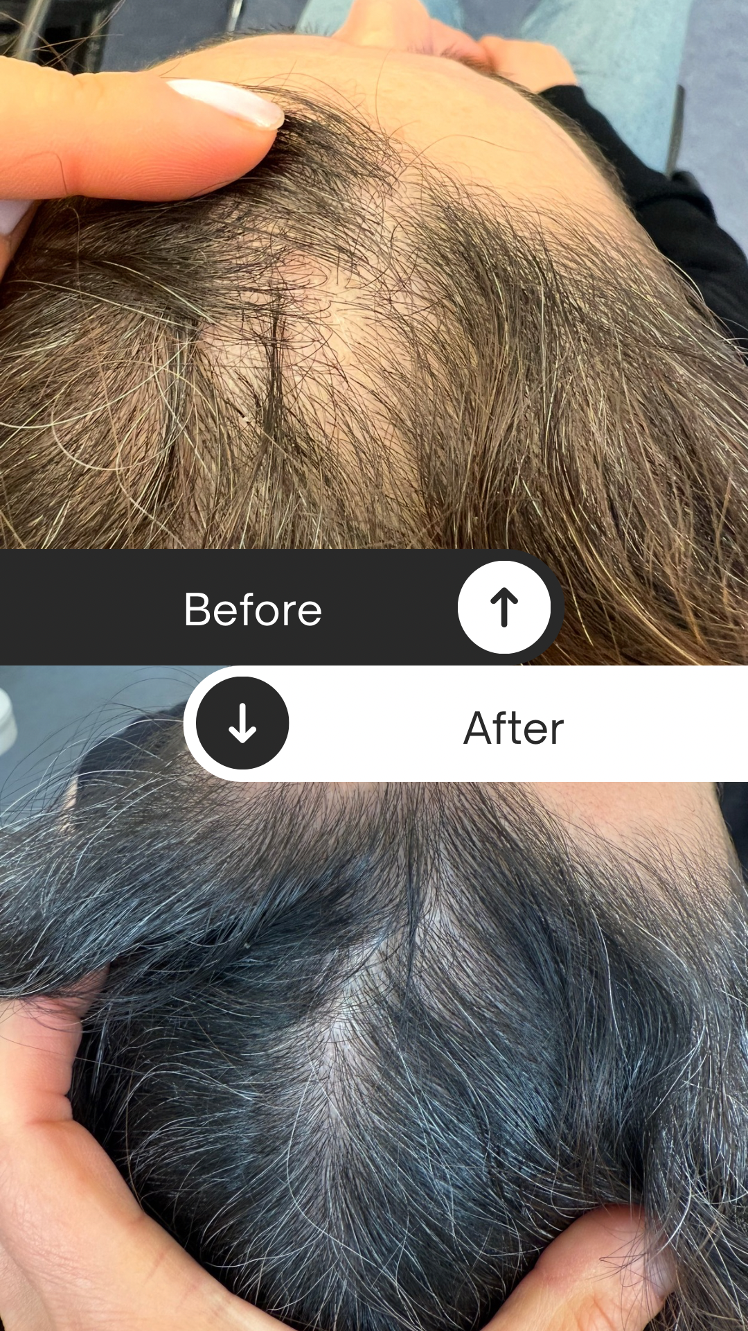Haare PRP, Ergebnisse nach 2 Behandlungen. Haarausfall